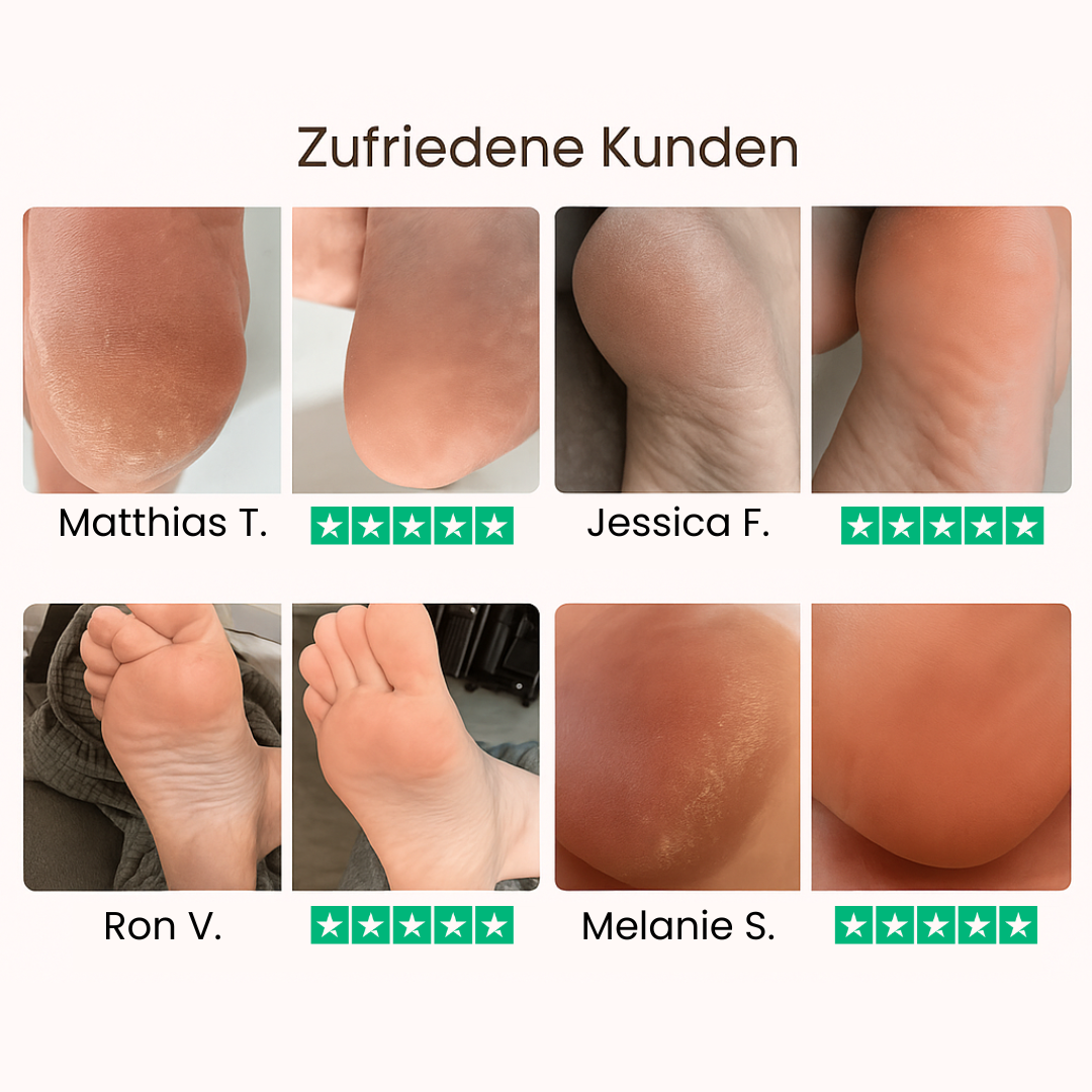 DermaLove Pro inkl. 60 Glide Pads (Gratis)